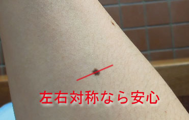 ほくろ